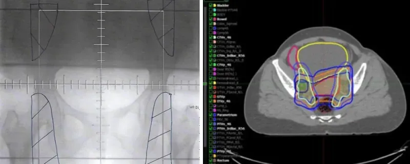 Examples of 2D vs. 3D radiotherapy treatment fields